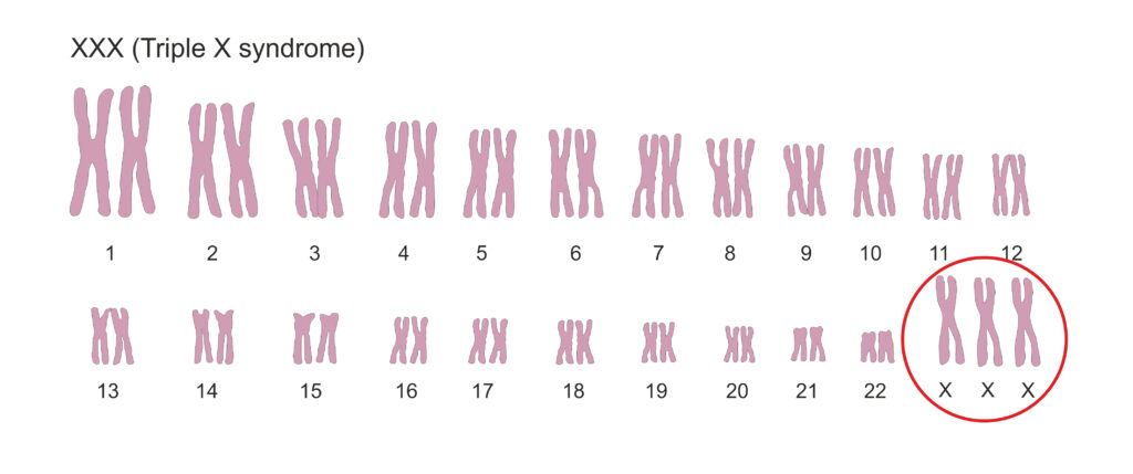 Een afbeelding van de chromosomen bij triple X syndroom: 47 structuren,  van het X chromosoom zijn er 3 in plaats van 2  