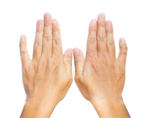 clinodactylie: handen waarvan de pinktopjes iets naar binnen staan, naar de ringvingers toe